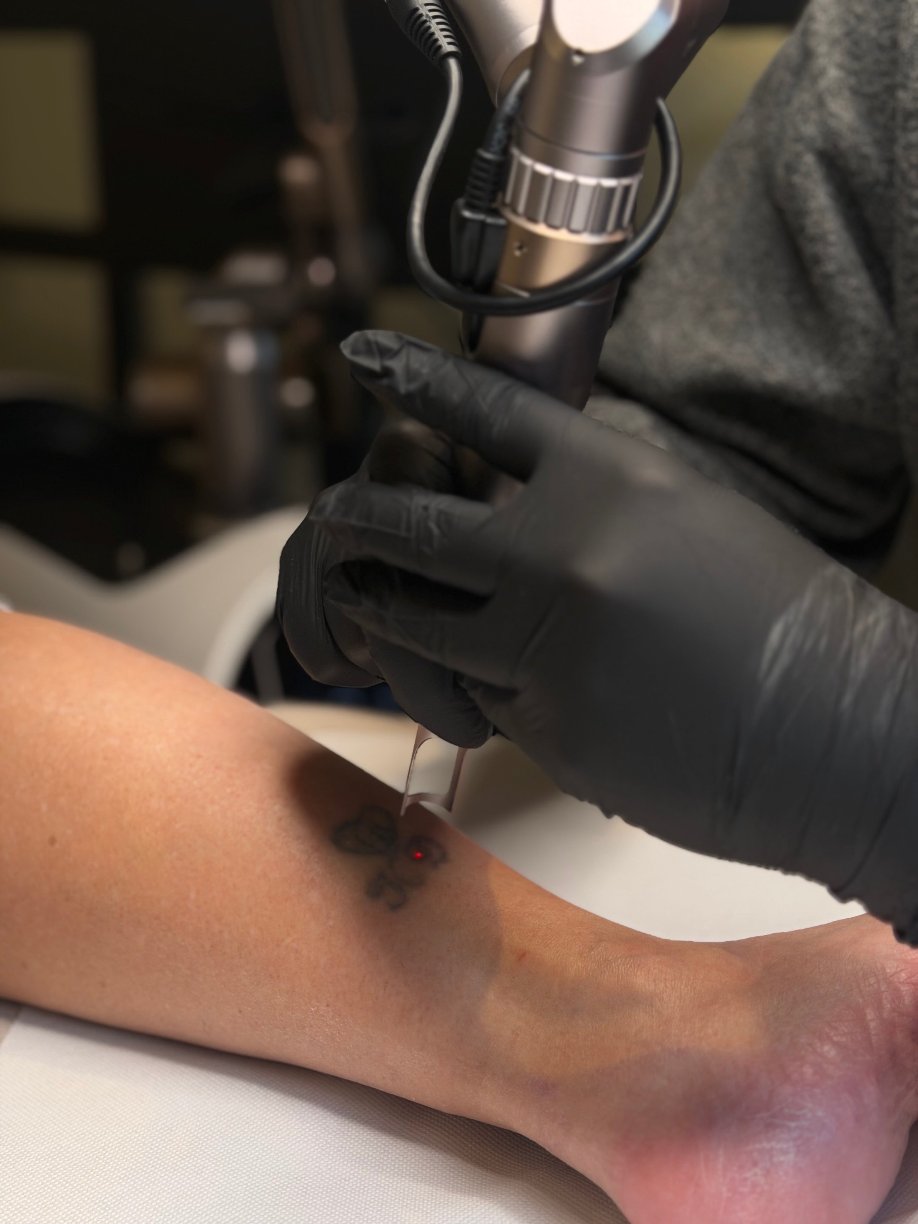 Tattoo laten verwijderen: waarom gaat het soms anders dan verwacht?